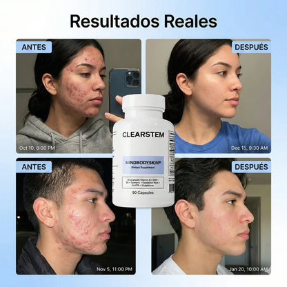 CLEARSTEM - CAPSULA PARA EL ACNE.